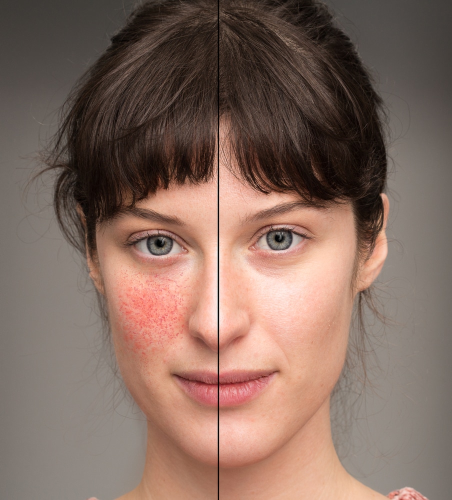 Acne Peel in Tucson 1 1783355365 aa1c4f3bf10c45dc8587ab153ab47a8e 1 1